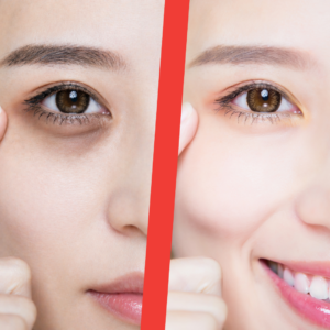 A split photo showing woman with dark eye circles on the left and then bright eyes after gel treatment on the right
